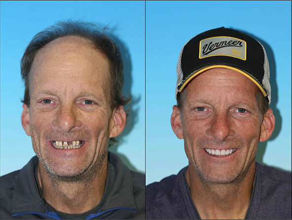 Cosmetic restoration dentist in denver