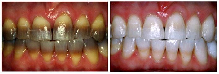 cosmetic dentistry before and after photos