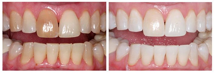 cosmetic dentistry before and after pictures