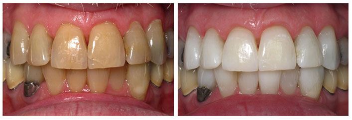 cosmetic dentistry before and after pictures