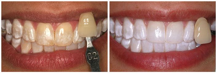 cosmetic dentistry before and after pictures