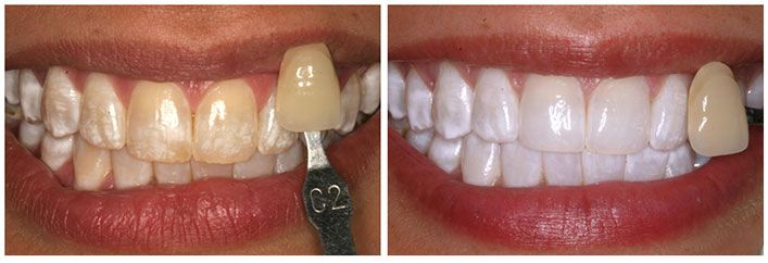 cosmetic dentistry before and after pictures