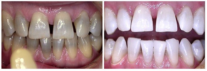 cosmetic dentistry before and after pictures