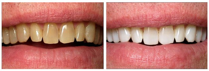 cosmetic dentistry before and after pictures