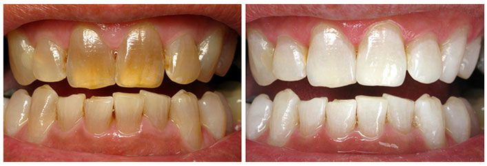 cosmetic dentistry before and after pictures