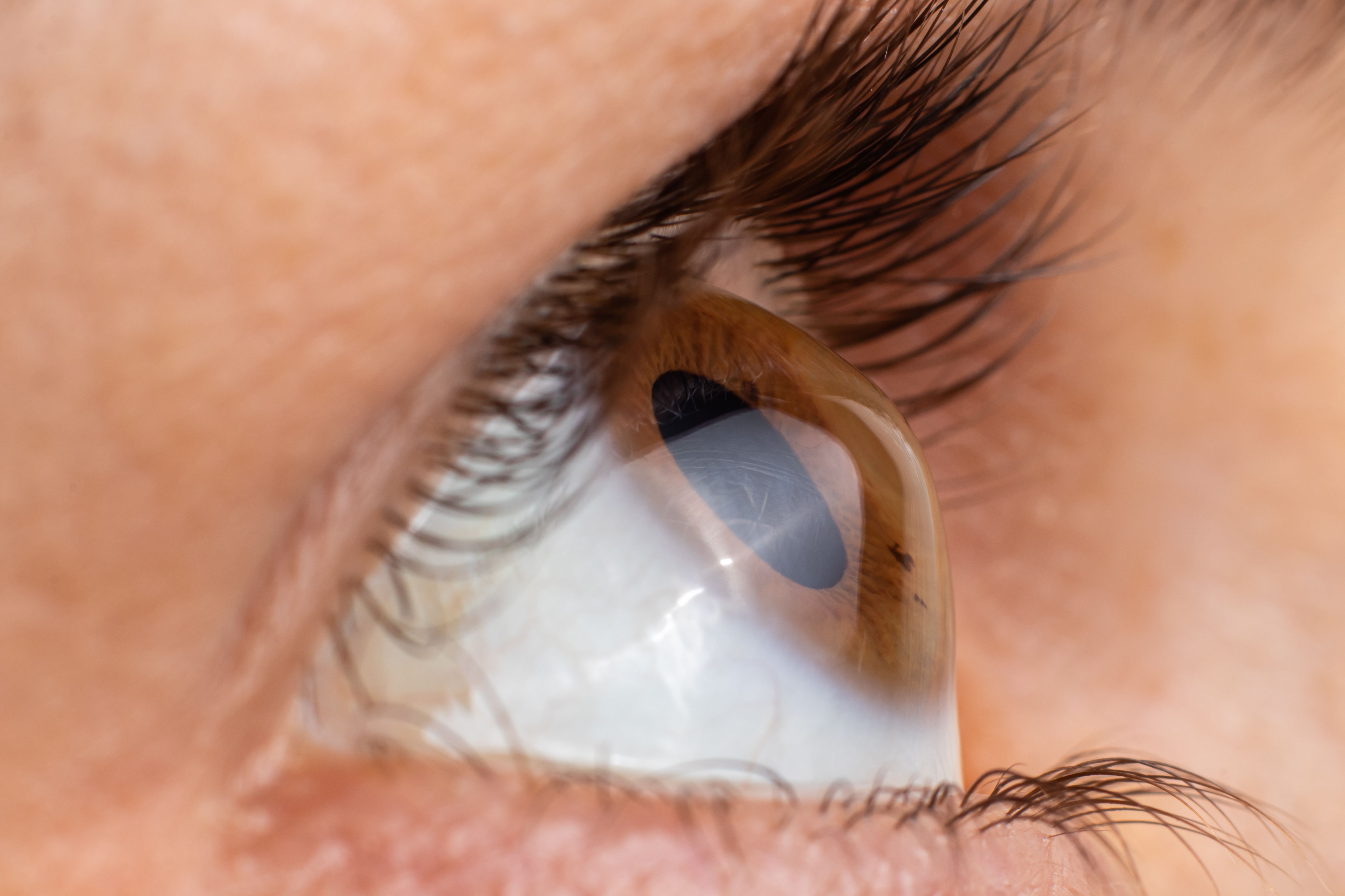 Keratoconus Explained: Early Signs and Why Early Diagnosis Matters