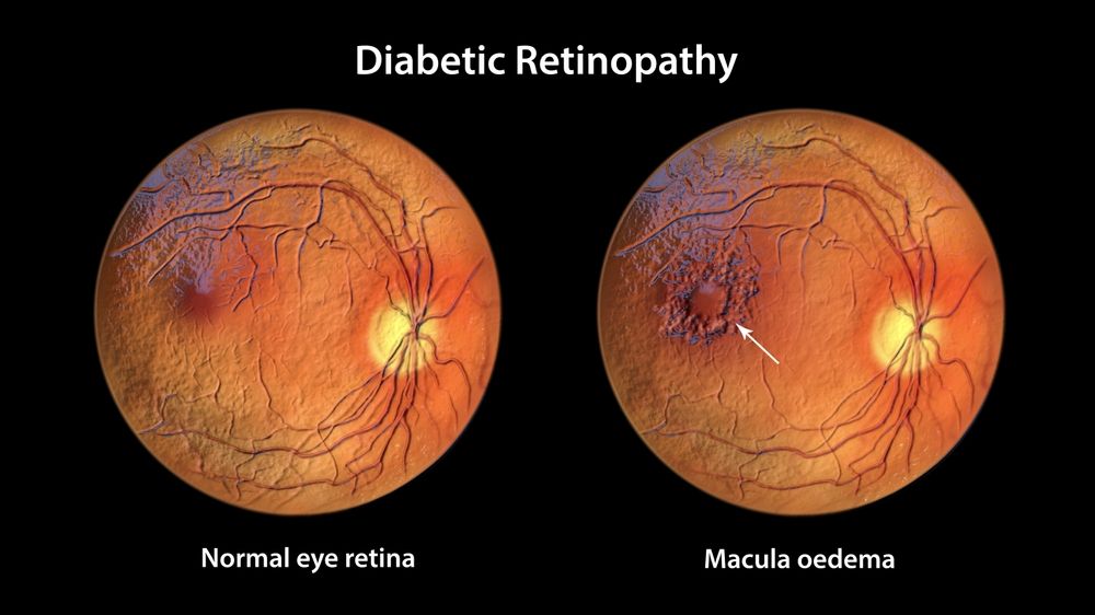 The 4 Stages of Diabetic Retinopathy Explained