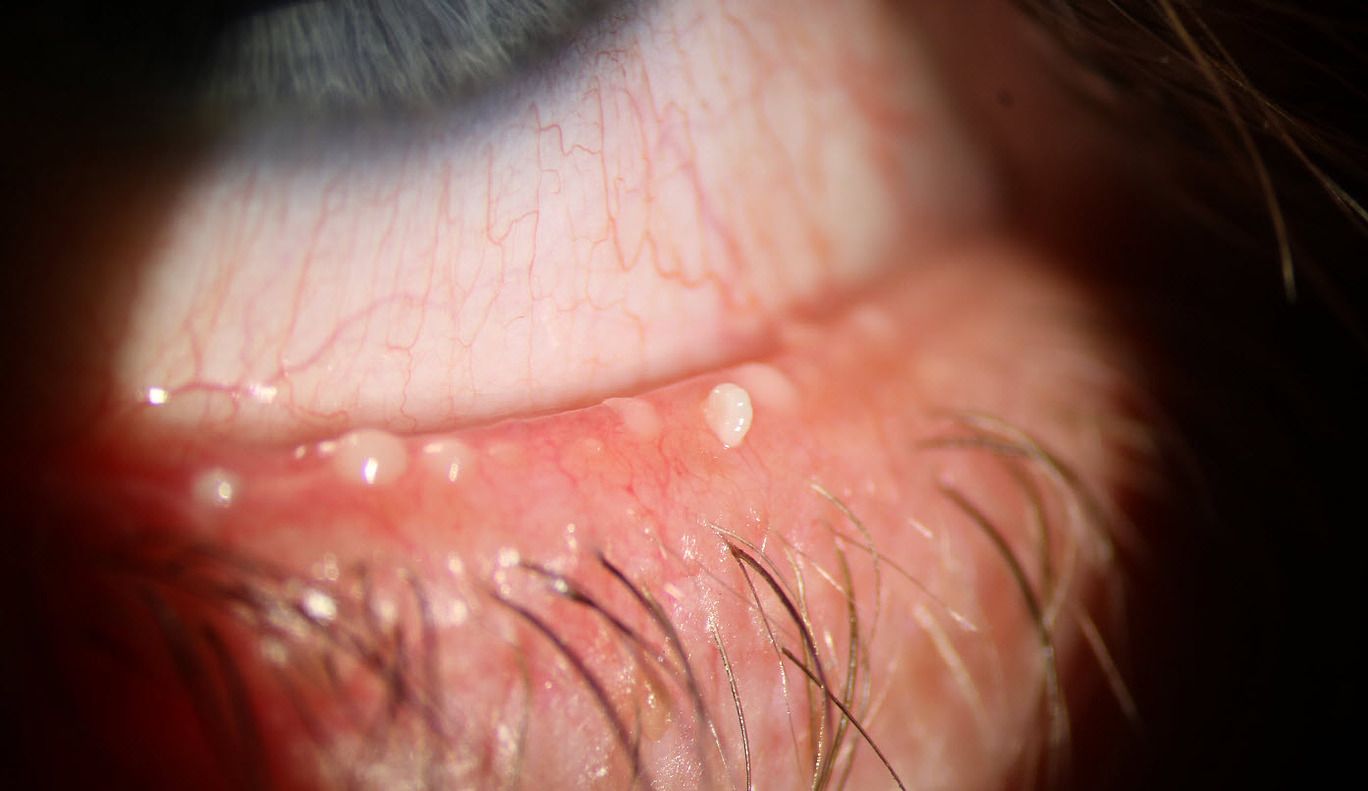 How to Tell if Your Dry Eye Needs Professional Treatment