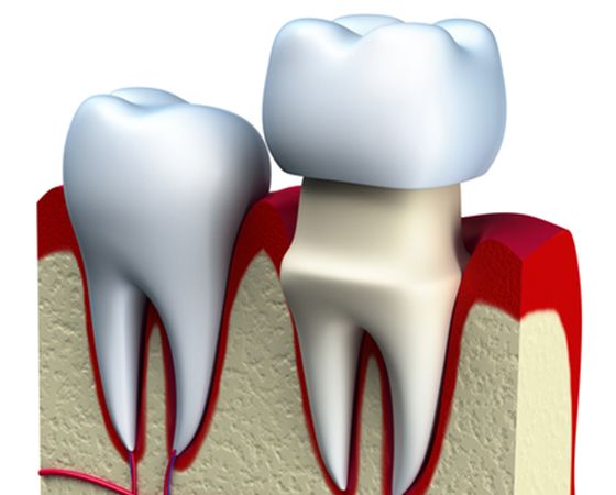 Dental Crowns and Bridges