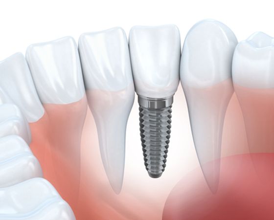 Dental Implants