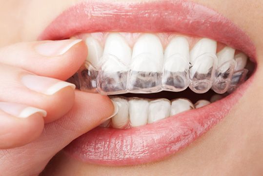Teeth Whitening