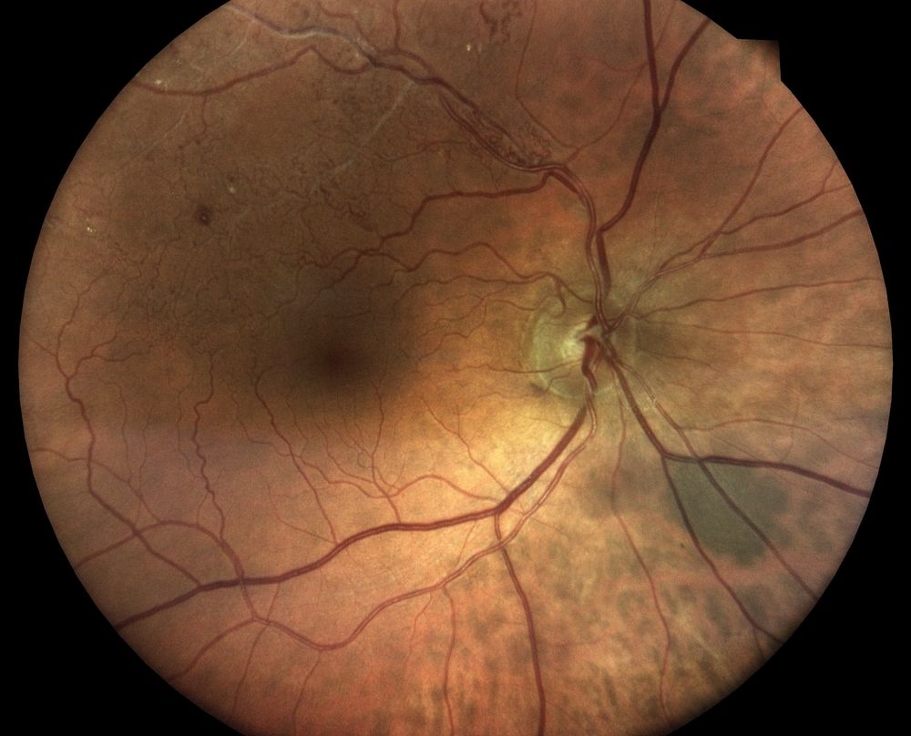 What are the Symptoms of Central Retinal Vein Occlusion?