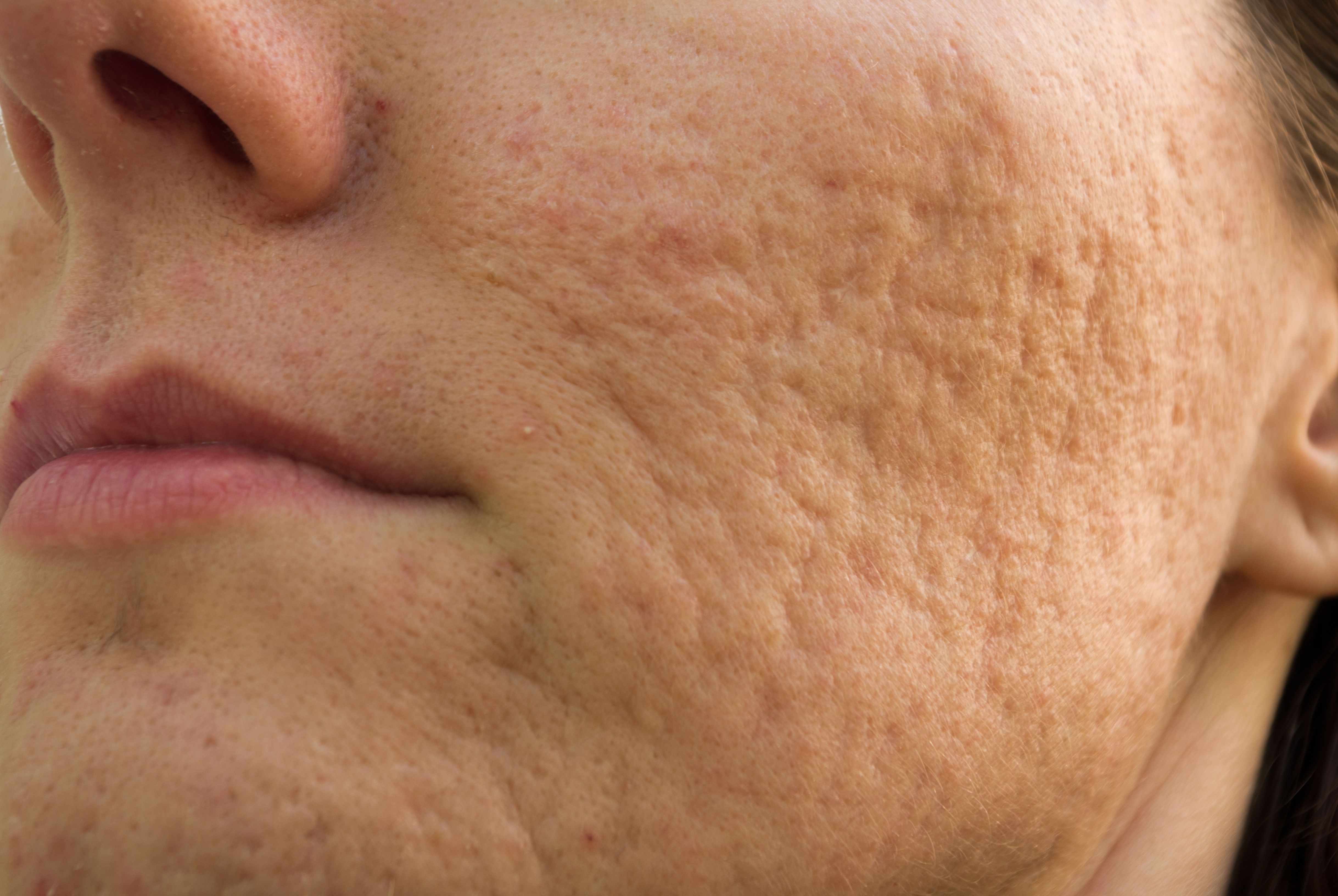 Struggling With Acne Scars? Choosing the Right Treatment for Your Skin