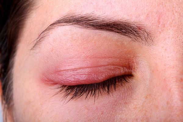 How To Prevent Blepharitis