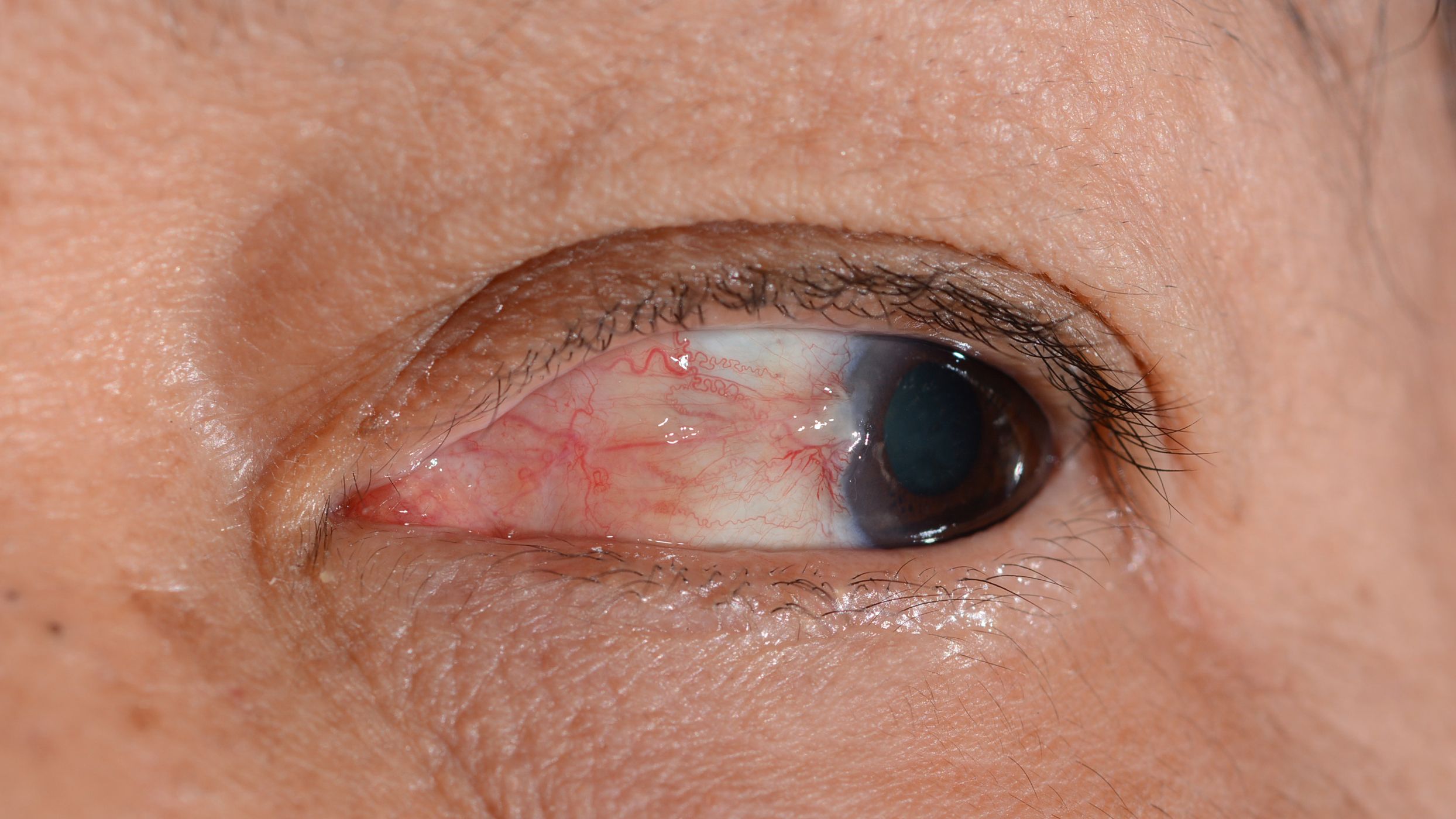 Pterygium image