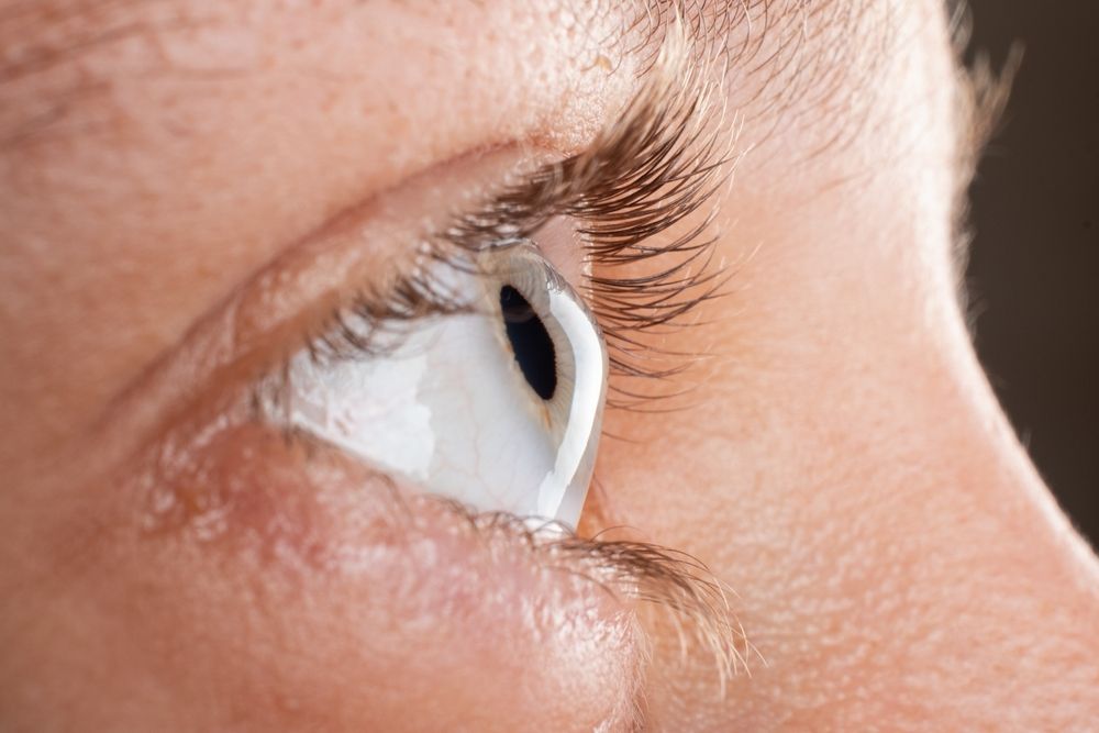 What Are the Four Stages of Keratoconus?