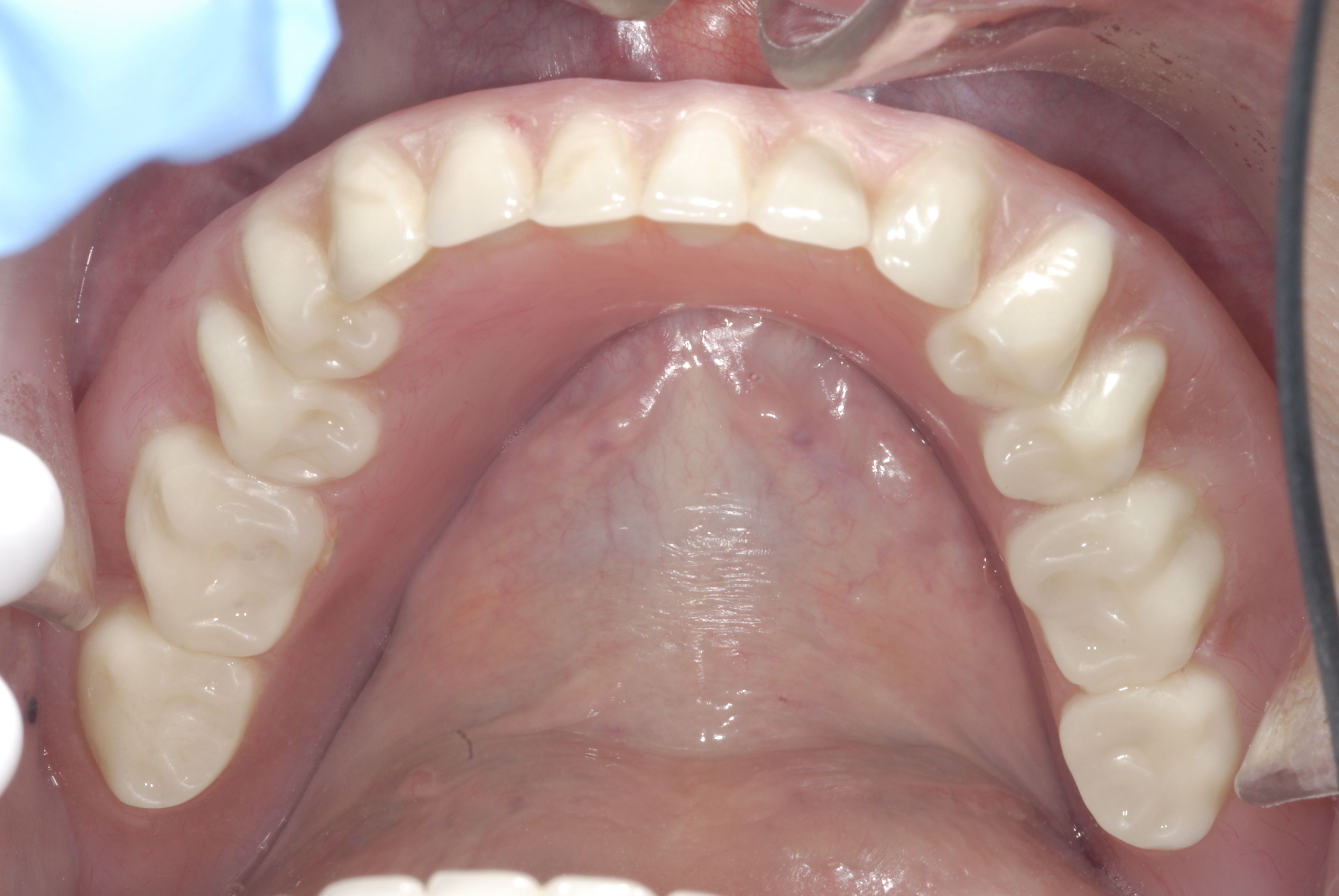 After Over Denture Implant