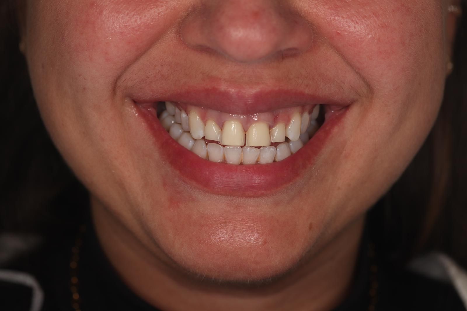 Porcelain Veneers vs. Composite Bonding: Which Option Is Right for You?