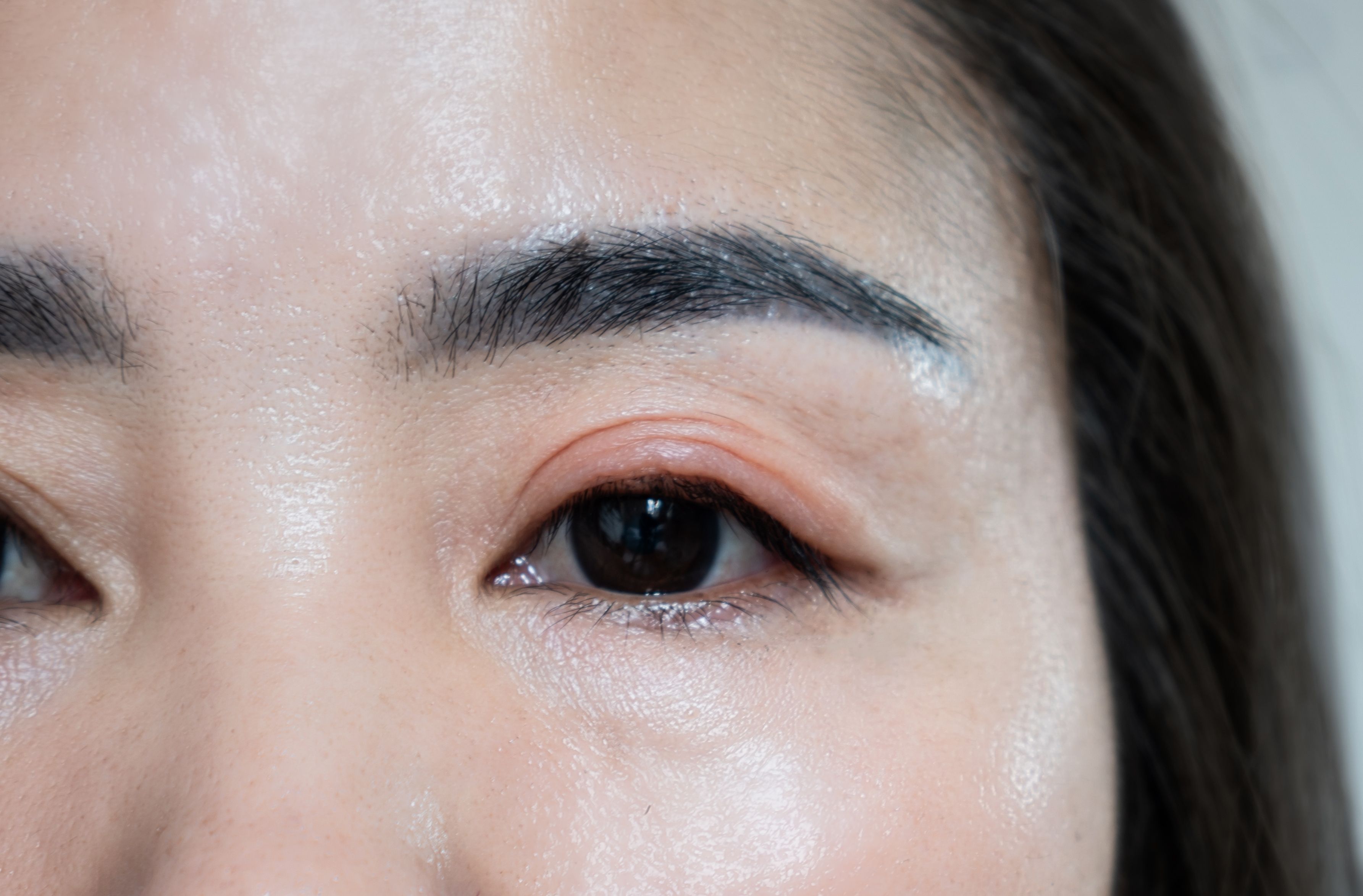 Meibomian Gland Probing: What to Expect from the Procedure