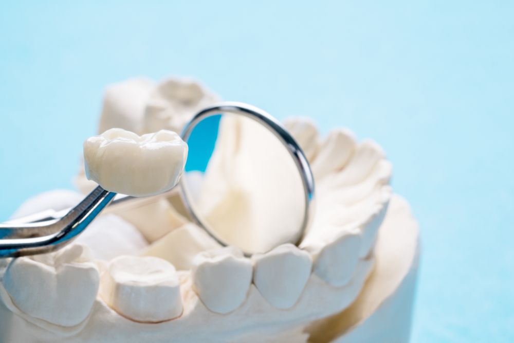 Signs You May Need a Dental Crown or Bridge