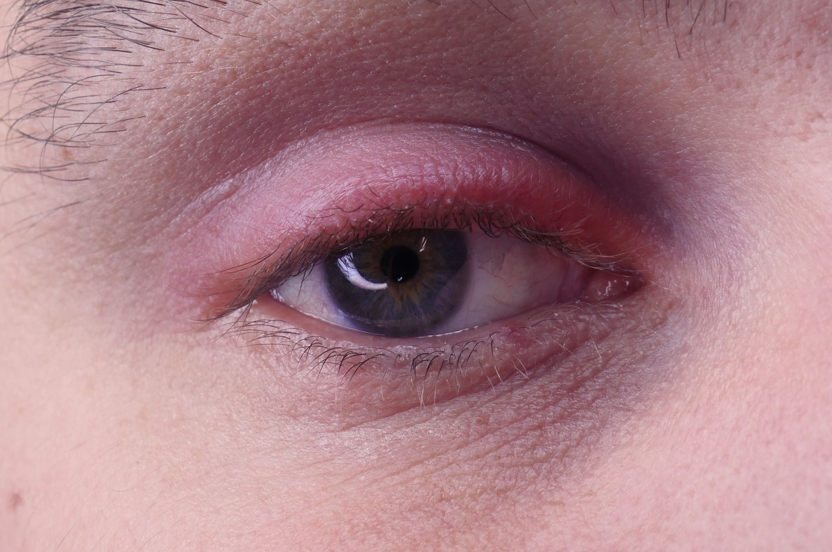 Does IPL Provide Long-Term Relief for Blepharitis?
