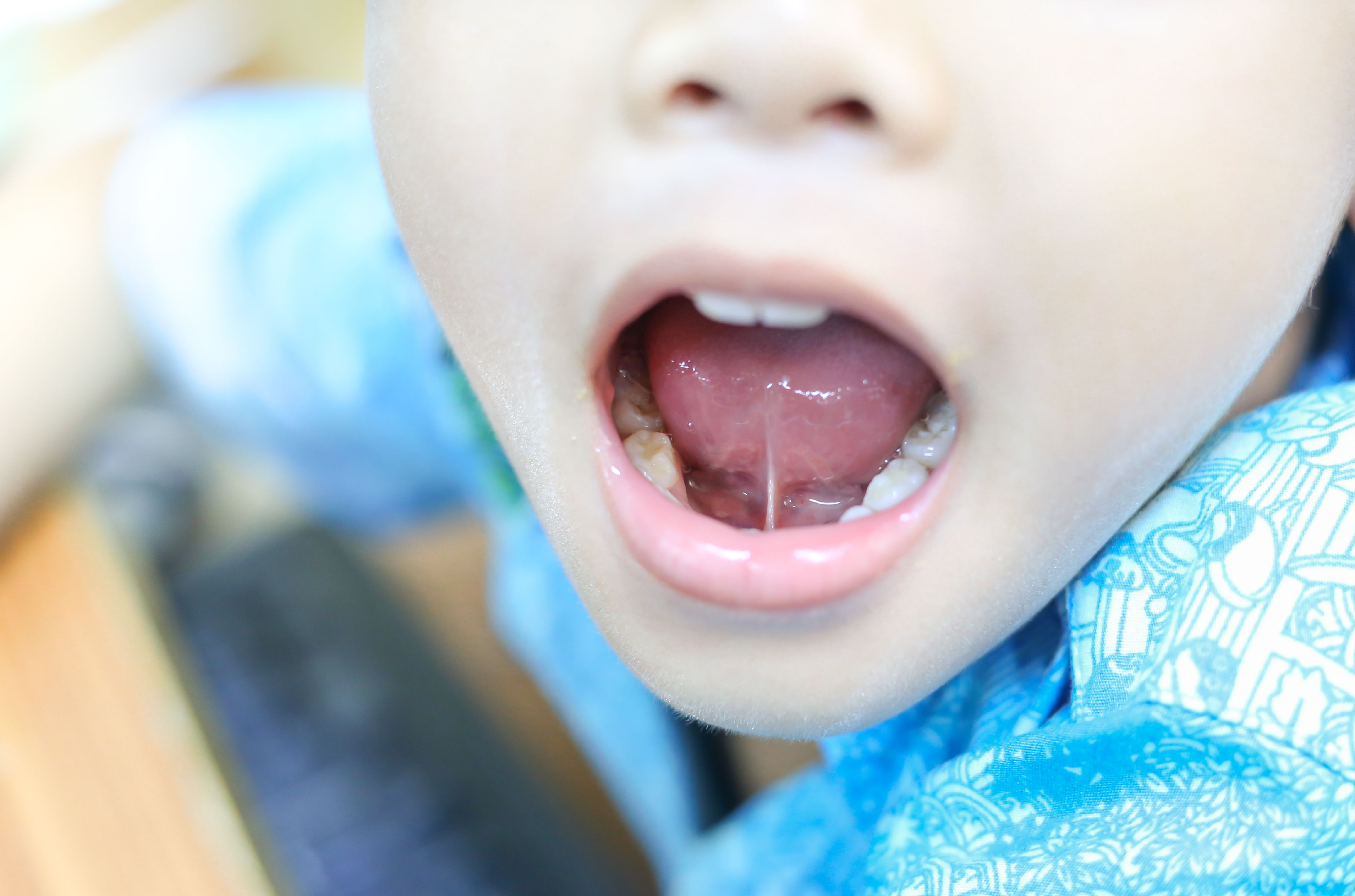 How a Tongue-Tie Can Affect Eating, Sleep, and Jaw Development