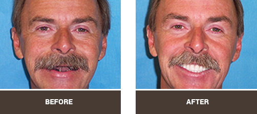 Before and After image of Full Arch Dental Implants in Las Vegas NV Area