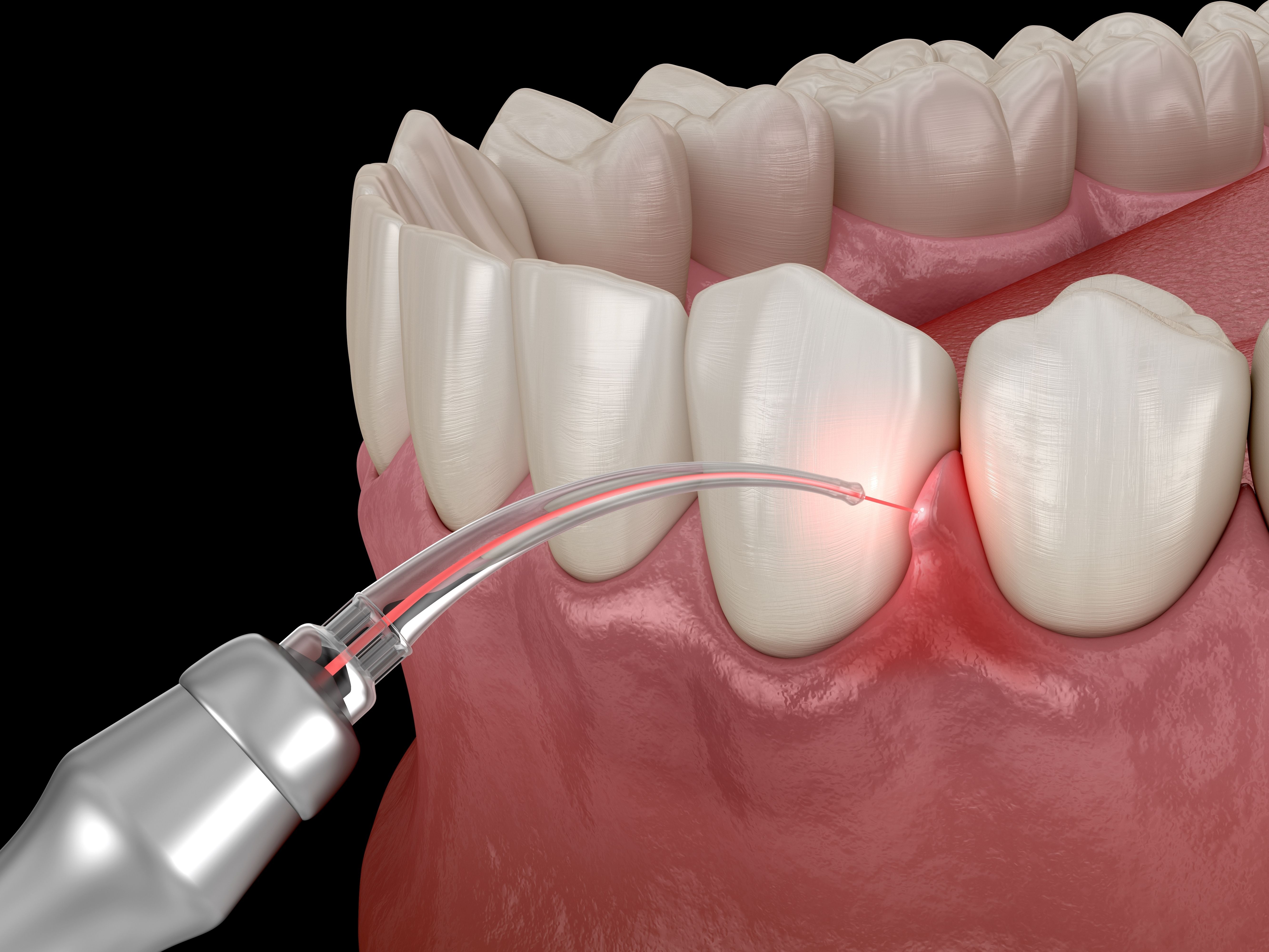 How Laser Dentistry Makes Dental Procedures Faster, Safer, and More Comfortable