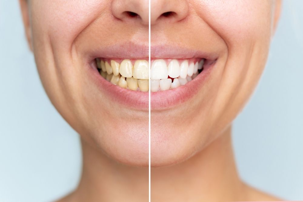Teeth Whitening: Professional Options vs. At-Home Products