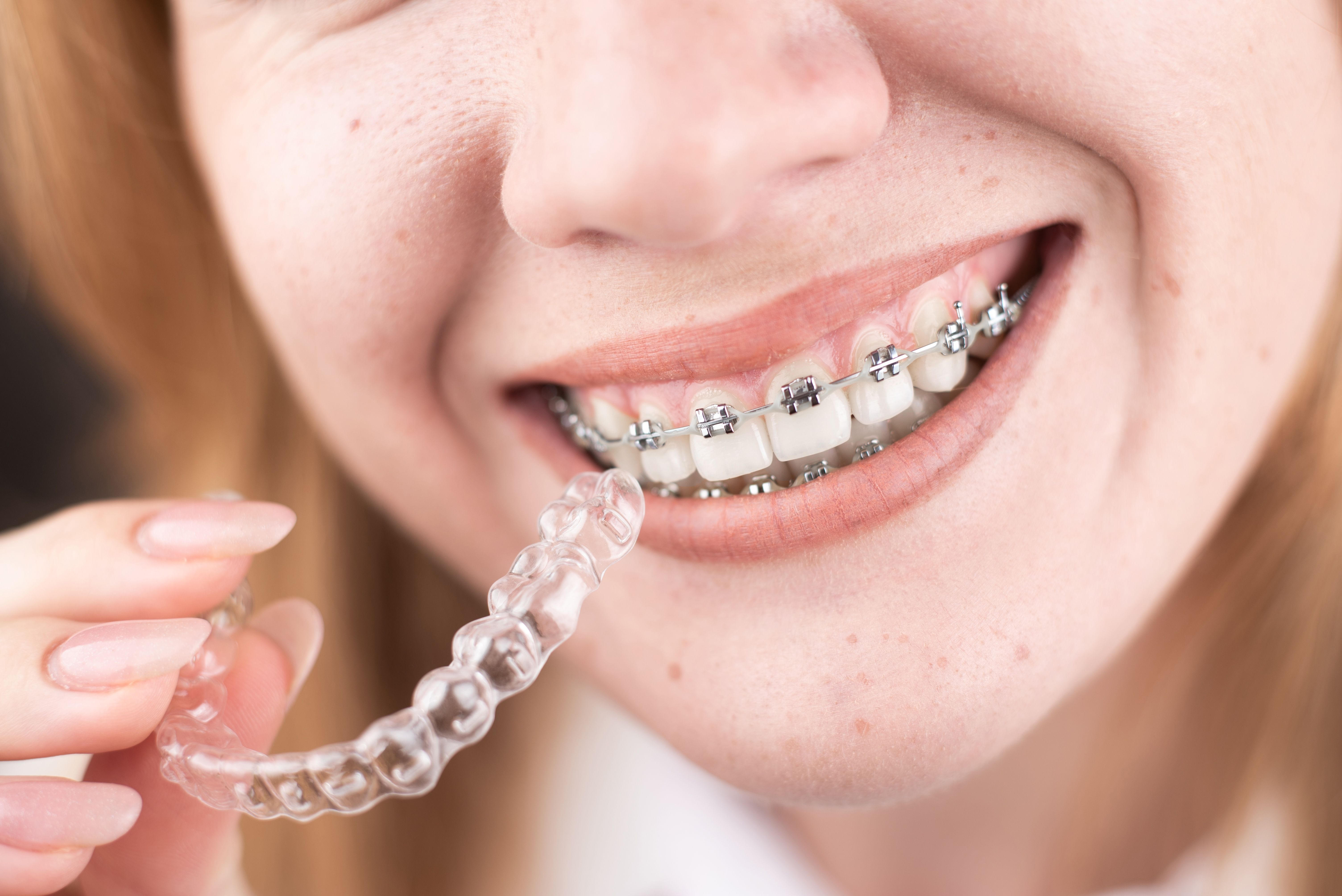 Aligners vs Metal Braces: What Are the Pros and Cons of Each?