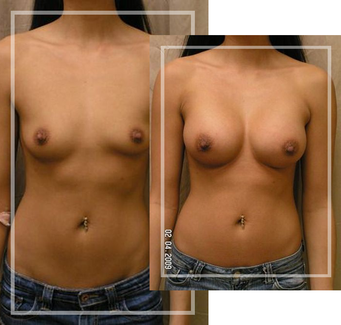 breast implants in metairie