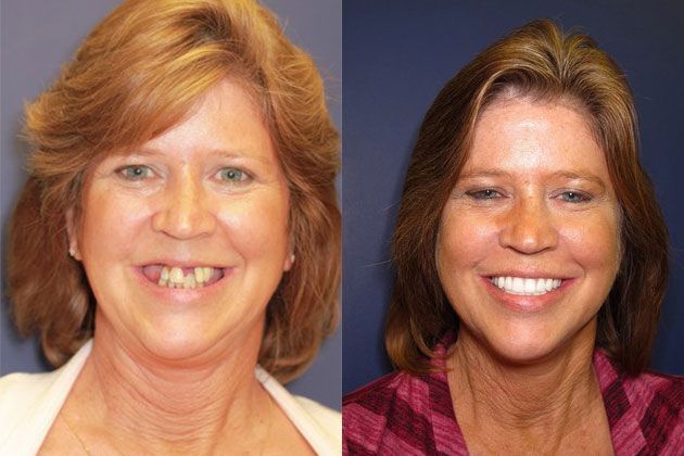 multiple missing teeth treatment