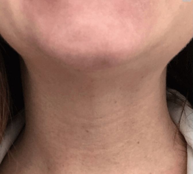 After Nonsurgical Neck Lift