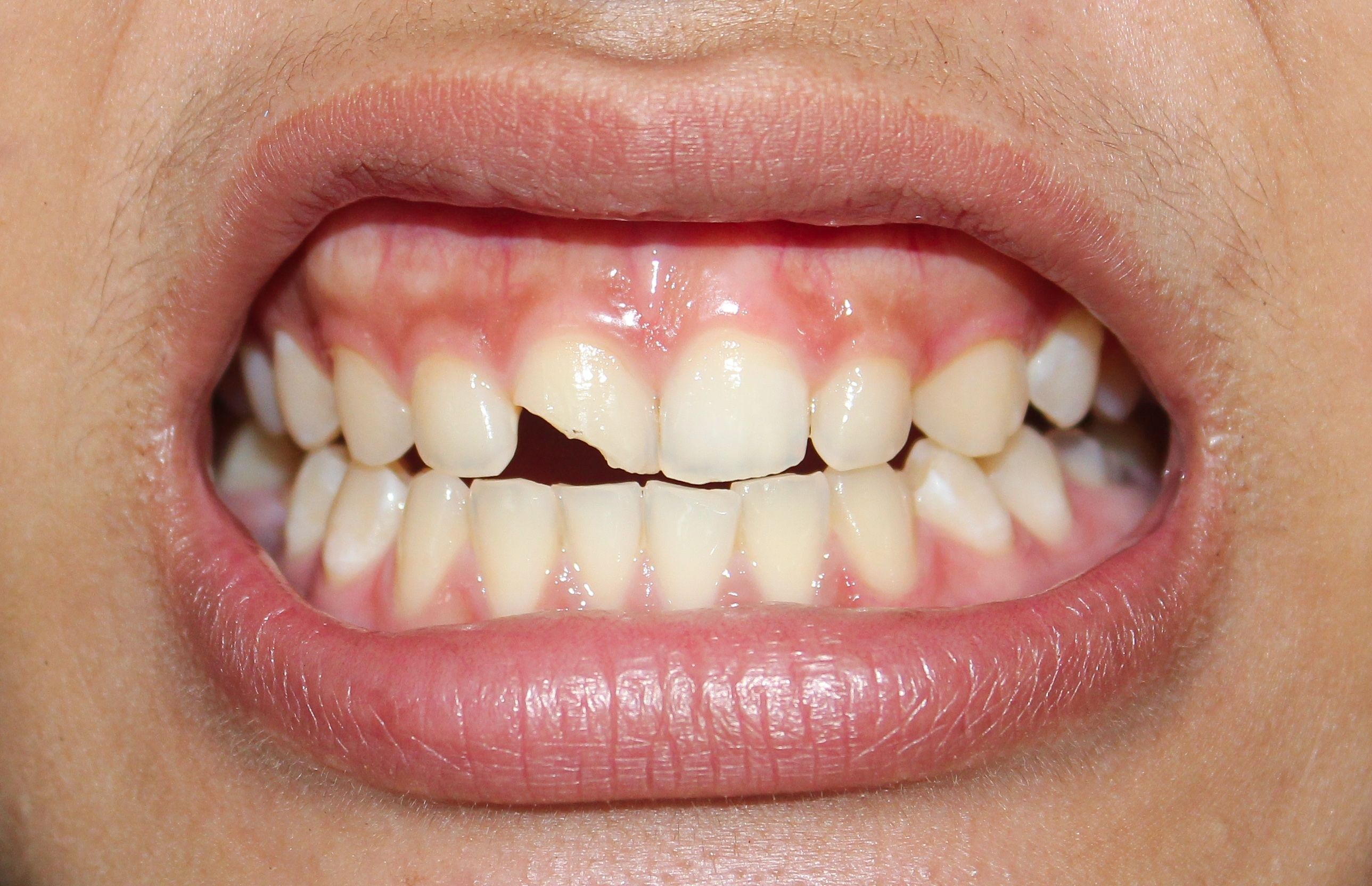 Repairing Chipped Teeth with Dental Bonding