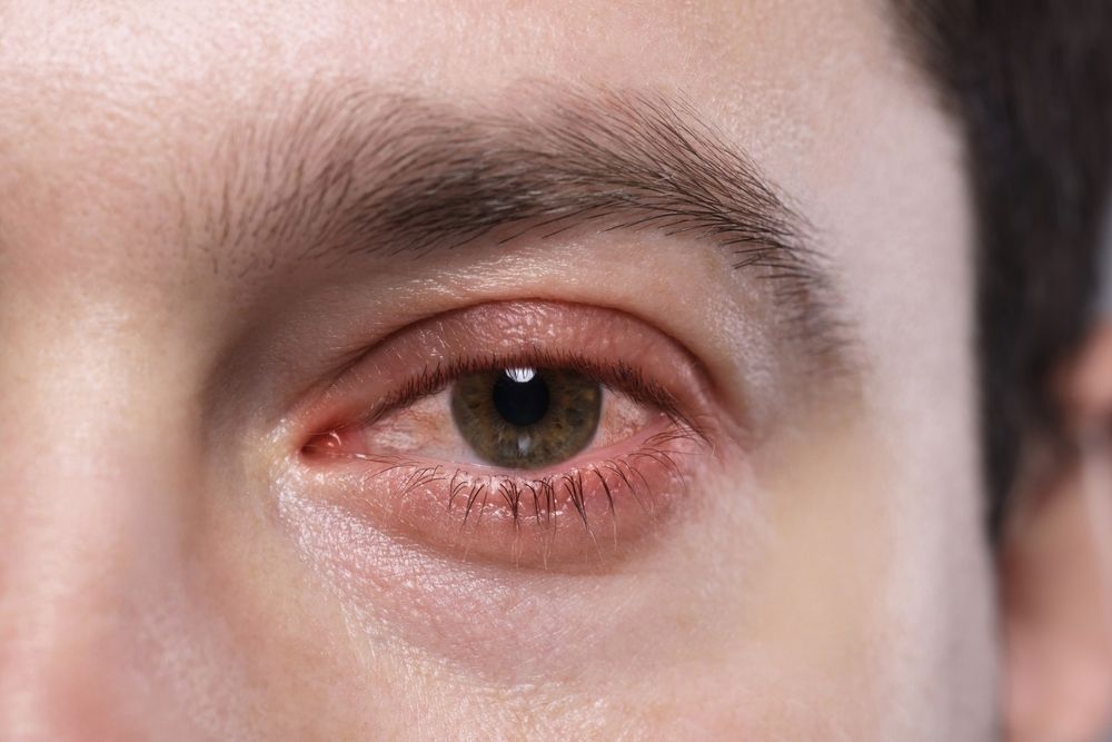 The Role of Inflammation in Chronic Dry Eye Disease