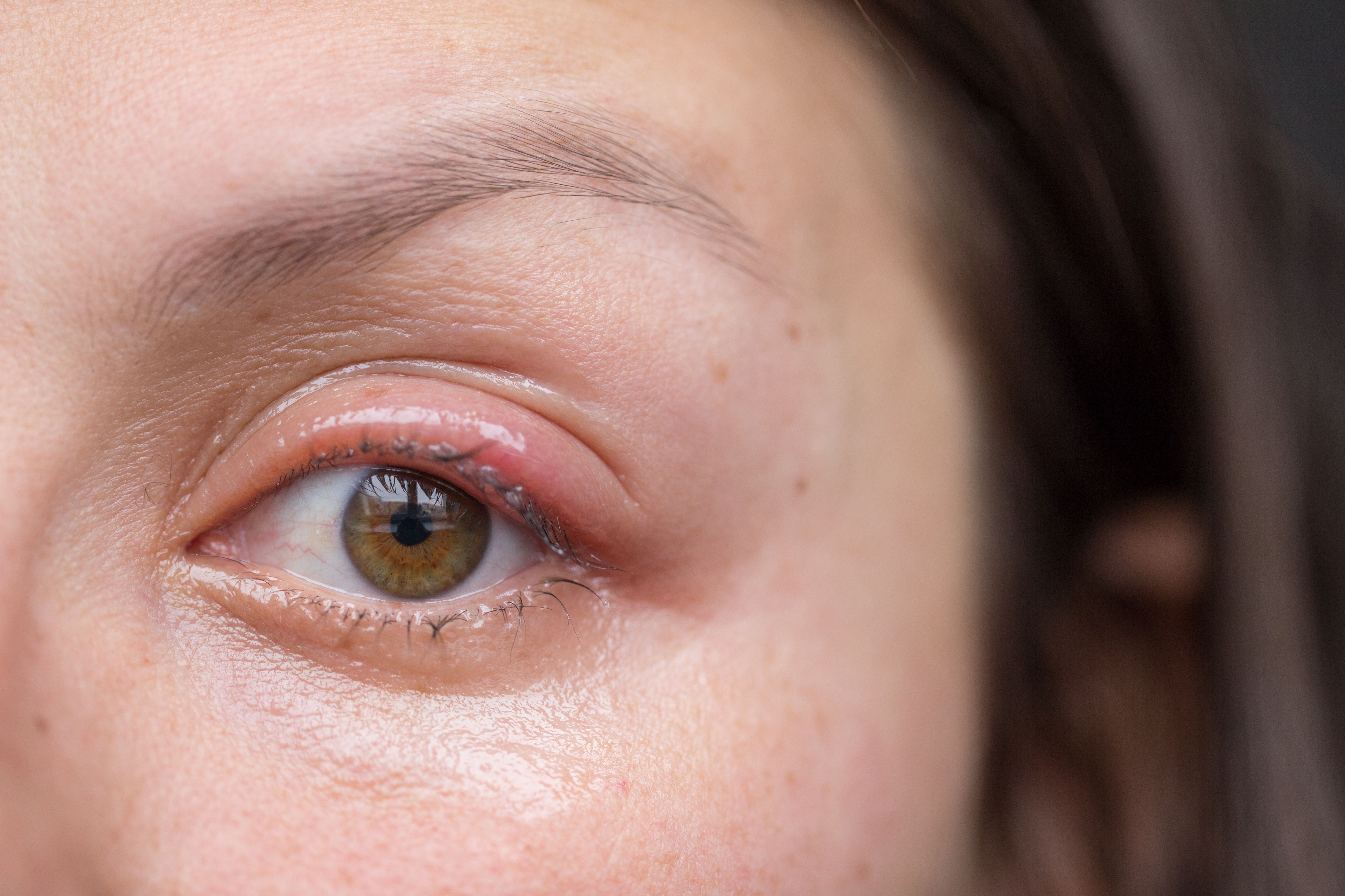 What Is the Best Way to Get Rid of Blepharitis?