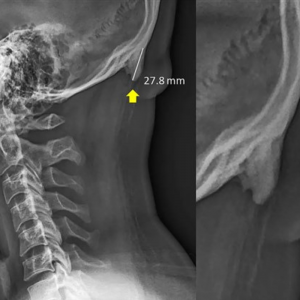 Tech Neck and Forward Head Posture X-Ray
