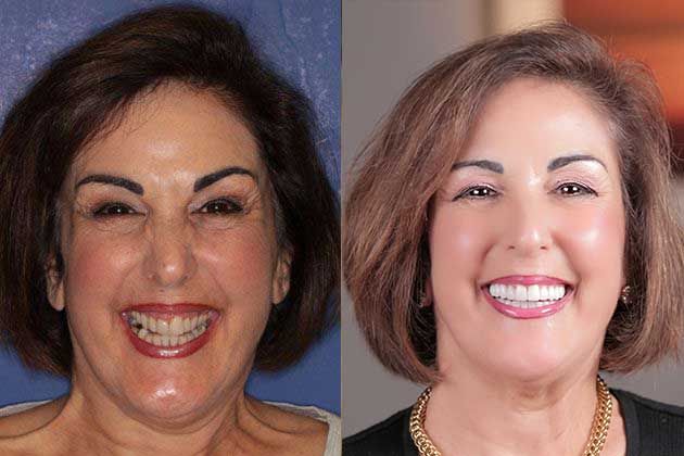 smile makeover