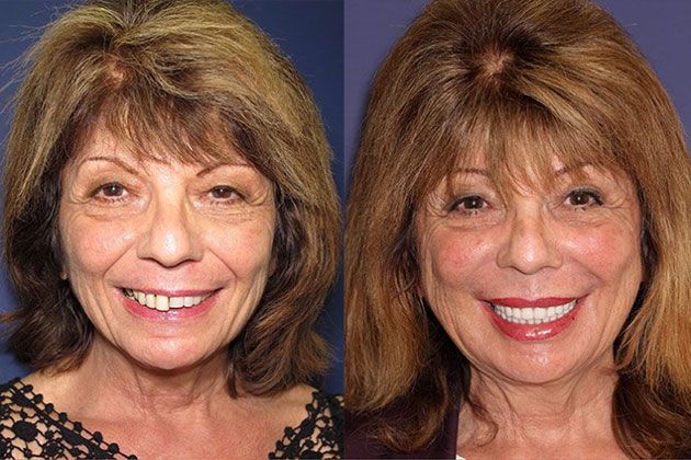 Dental Implant: Dental Implants and Fixed Porcelain Bridgework using IV Sedation