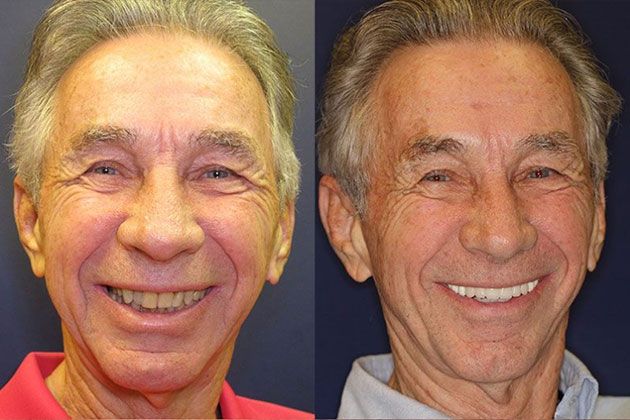 Dental Implant: Dental Implants and Fixed Porcelain Bridgework using IV Sedation
