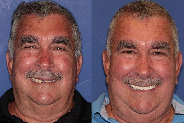 Dental Implant: Dental Implants and Fixed Porcelain Bridgework using IV Sedation
