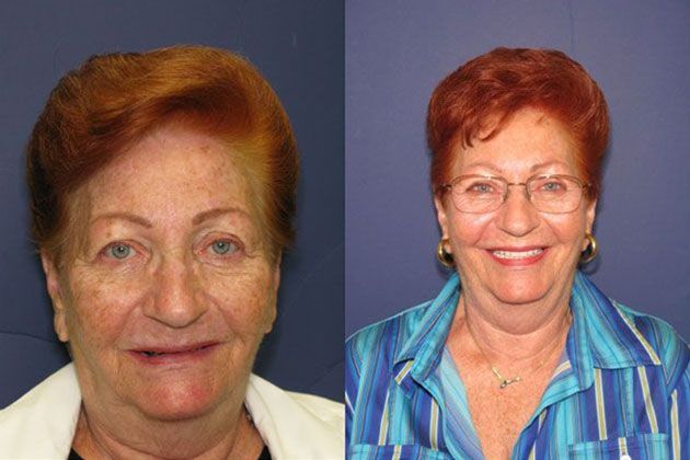 Dental Implant: Dental Implants and Fixed Porcelain Bridgework using IV Sedation