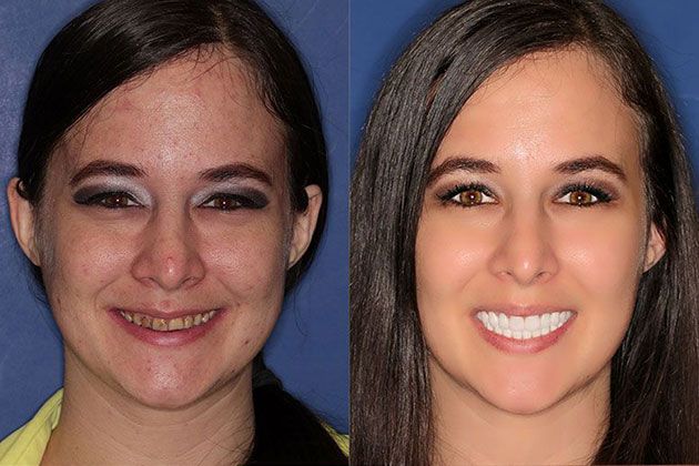 Dental Implant: Dental Implants and Fixed Porcelain Bridgework using IV Sedation