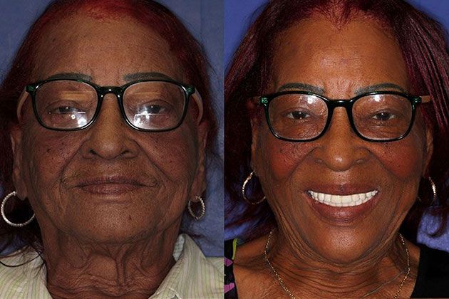 Dental Implant: Dental Implants and Fixed Porcelain Bridgework using IV Sedation