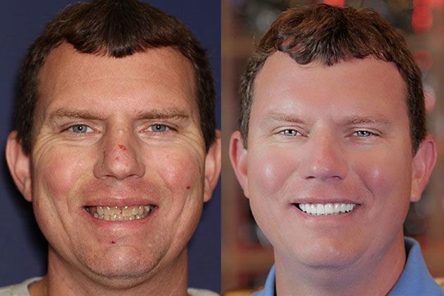 Dental Implant: Dental Implants and Fixed Porcelain Bridgework using IV Sedation