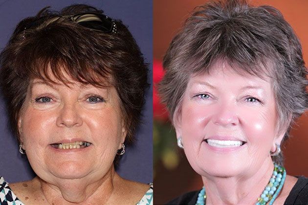 Dental Implant: Dental Implants and Fixed Porcelain Bridgework using IV Sedation