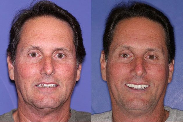 Dental Implant: Dental Implants and Fixed Porcelain Bridgework using IV Sedation