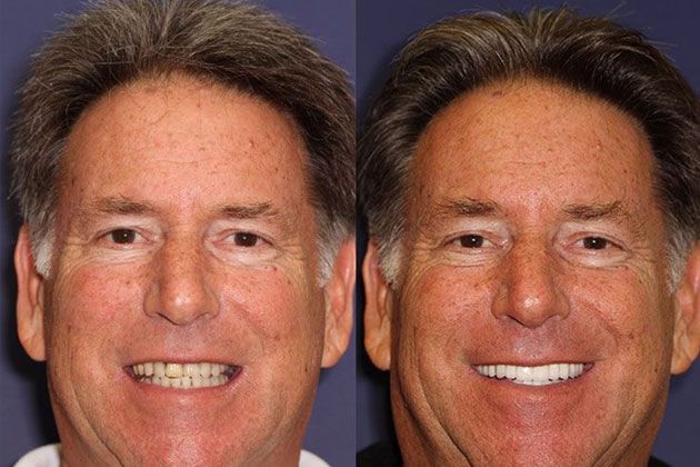 Dental Implant: Dental Implants and Fixed Porcelain Bridgework using IV Sedation