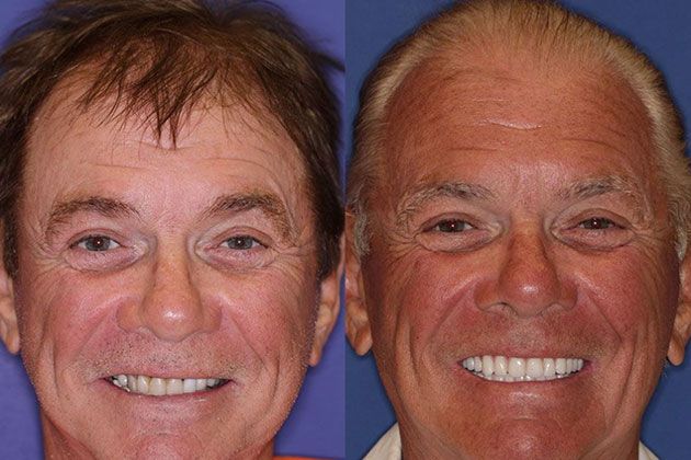 Dental Implant: Dental Implants and Fixed Porcelain Bridgework using IV Sedation