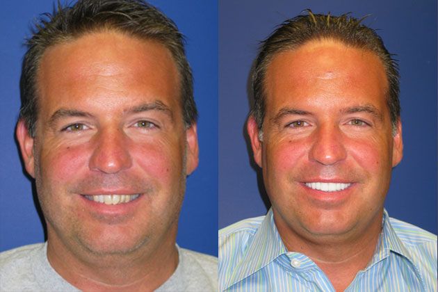Smile Makeover / Smile Lift : Smile Lift with Cosmetic Porcelain Veneers